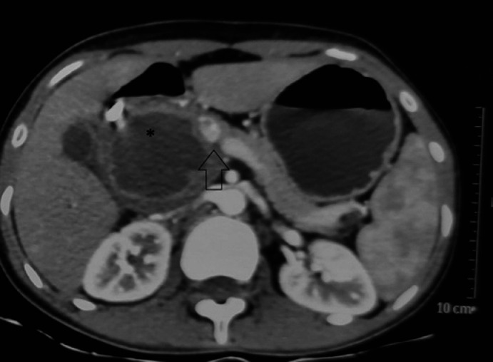 Successful Use of Direct Splenic Vein Anastomosis to the Interposition Internal Jugular Vein Graft after Extended Pancreatoduodenectomy to Avoid Sinistral Portal Hypertension.