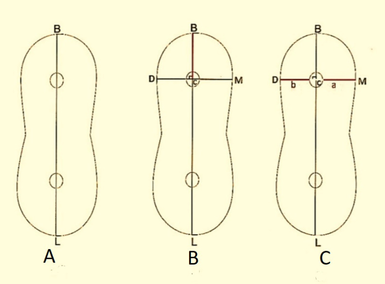 Comparison of the Efficacy of NeoNiTi, ProTaper, and Reciproc Files in the Retreatment of Curved Root Canals: a CBCT Assessment.