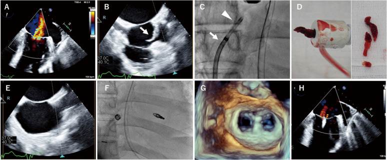 Successful Giant Thrombus Aspiration Using a Guide Cather in the Right Atrium Before Emergency Transcatheter Edge-to-Edge Mitral Valve Repair.