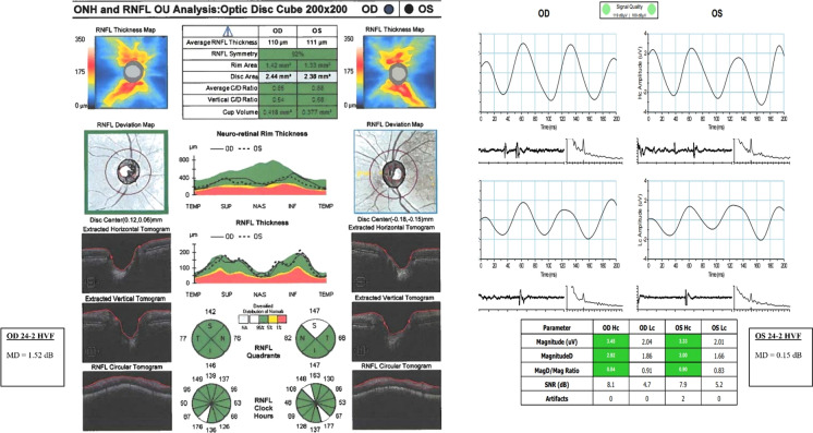 Structure-function models for estimating retinal ganglion cell count using steady-state pattern electroretinography and optical coherence tomography in glaucoma suspects and preperimetric glaucoma: an electrophysiological pilot study.