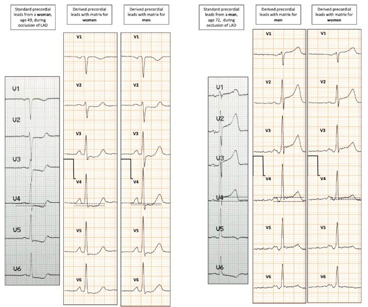 Clinical validation of a 13-lead electrocardiogram derived from a self-applicable 3-lead recording for diagnosis of myocardial supply ischaemia and common non-ischaemic electrocardiogram abnormalities at rest.