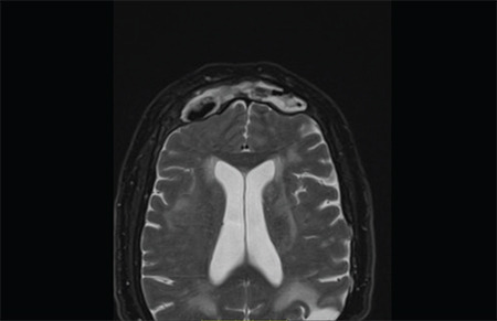 Frontal Sinus Cholesteatoma Presenting with Intracranial and Orbital Complications: Diagnosis and Treatment.