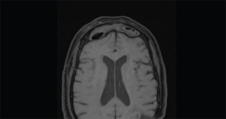 Frontal Sinus Cholesteatoma Presenting with Intracranial and Orbital Complications: Diagnosis and Treatment.