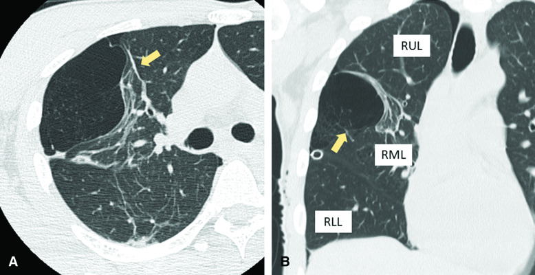 Unexpected Histopathological Diagnosis of Placental Transmogrification of the Lung after Bullectomy for Recurrent Spontaneous Pneumothorax: A Case Report and Literature Review.