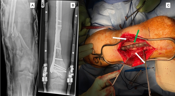 Bone defect treatment: does the type and properties of the spacer affect the induction of Masquelet membrane? Evidence today.