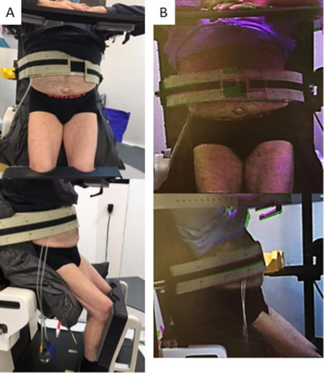 Upright patient positioning for pelvic radiotherapy treatments