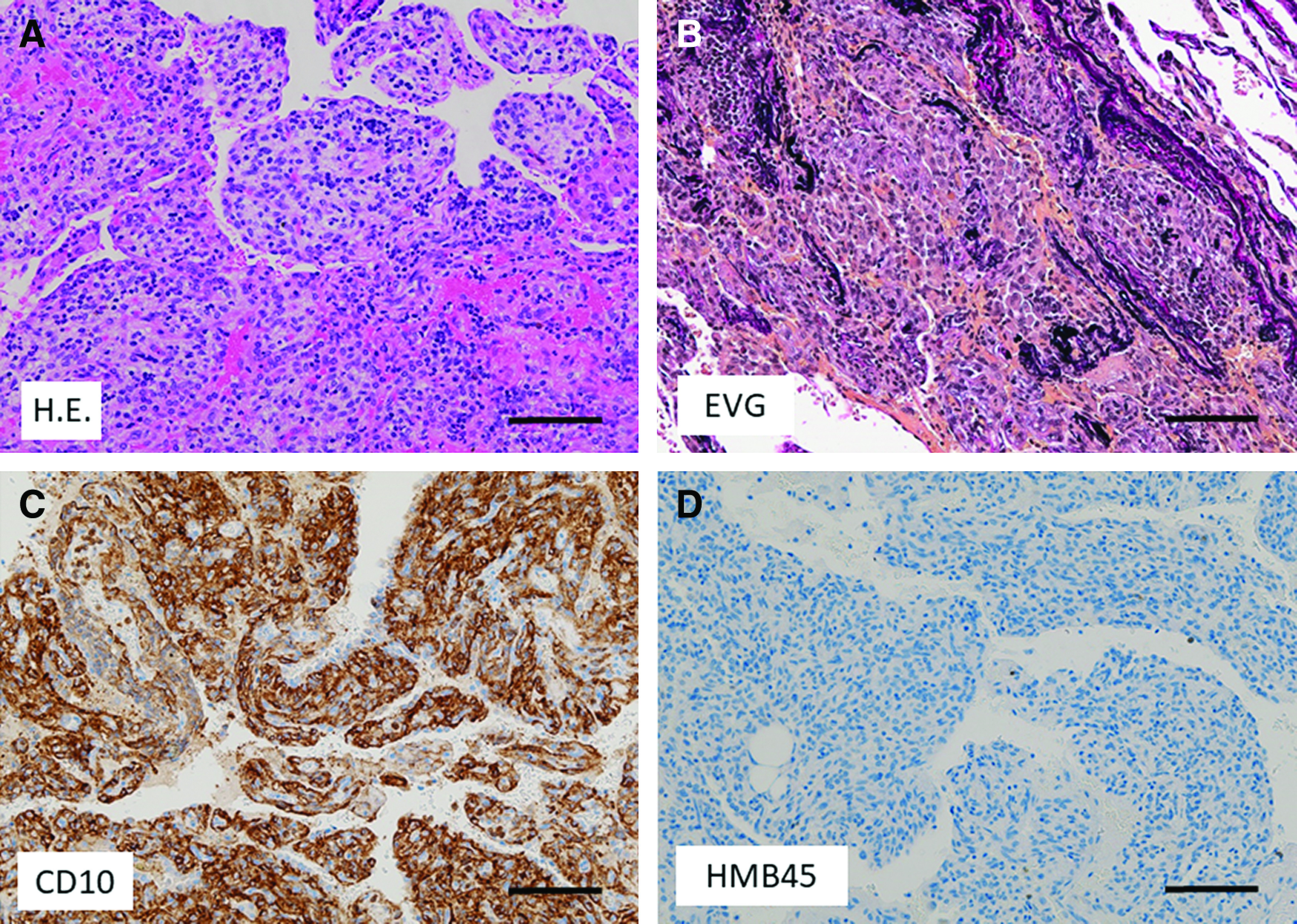 Unexpected Histopathological Diagnosis of Placental Transmogrification of the Lung after Bullectomy for Recurrent Spontaneous Pneumothorax: A Case Report and Literature Review.