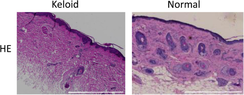 RUNX3 mediates keloid fibroblast proliferation through deacetylation of EZH2 by SIRT1.