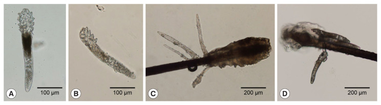 Demodex Blepharitis: An Analysis of Nine Patients.