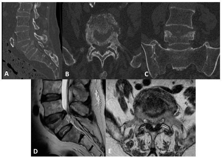 Novel Polyethylene Terephthalate Screw Sleeve Implant: Salvage Treatment in a Case of Spine Instability after Vertebroplasty Failure.