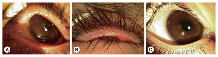 Demodex Blepharitis: An Analysis of Nine Patients.