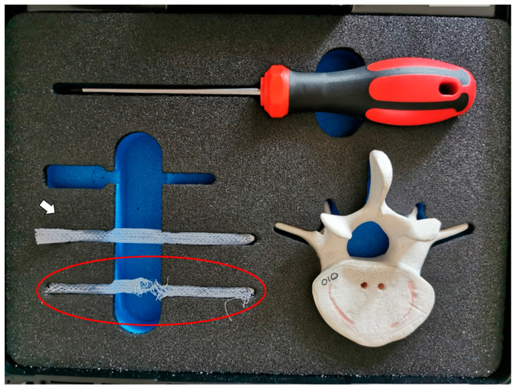 Novel Polyethylene Terephthalate Screw Sleeve Implant: Salvage Treatment in a Case of Spine Instability after Vertebroplasty Failure.