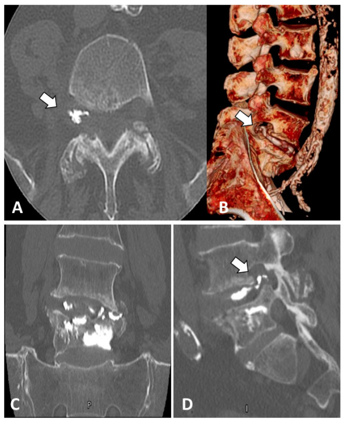 Novel Polyethylene Terephthalate Screw Sleeve Implant: Salvage Treatment in a Case of Spine Instability after Vertebroplasty Failure.