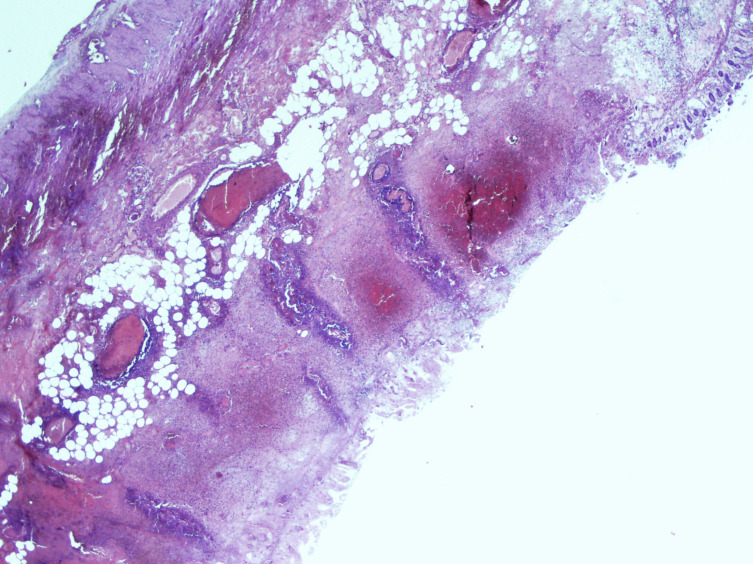 Acute mesenteric thrombosis in a pregnant woman with Factor V Leiden mutation with a history of in vitro fertilization and embryo transfer: case report and literature review