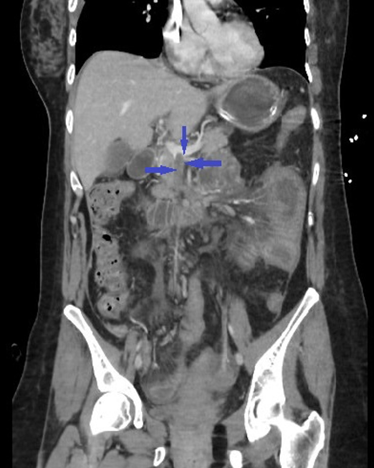 Acute mesenteric thrombosis in a pregnant woman with Factor V Leiden mutation with a history of in vitro fertilization and embryo transfer: case report and literature review