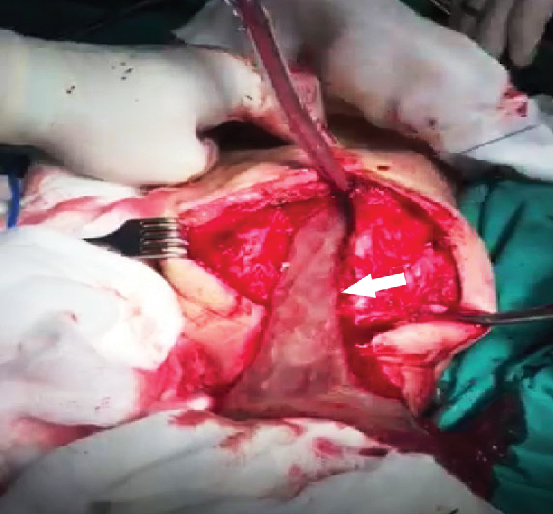 Femur Osteomyelitis and Associated Fracture as an Initial Presentation of Aortoenteric Fistula.