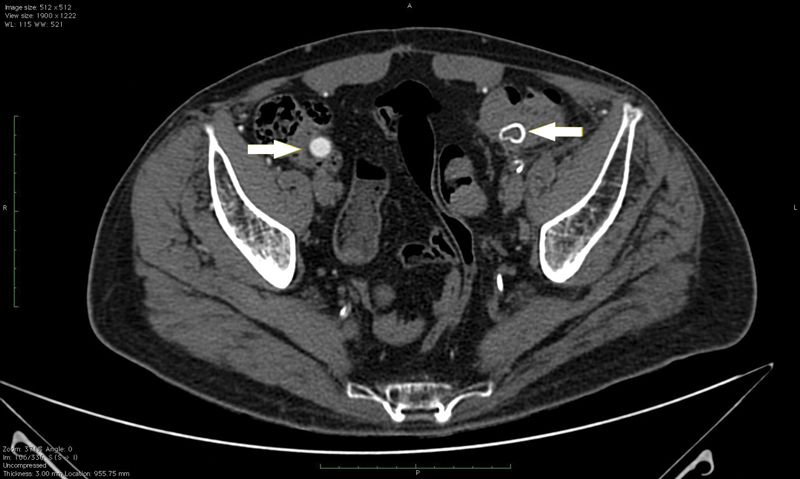 Femur Osteomyelitis and Associated Fracture as an Initial Presentation of Aortoenteric Fistula.