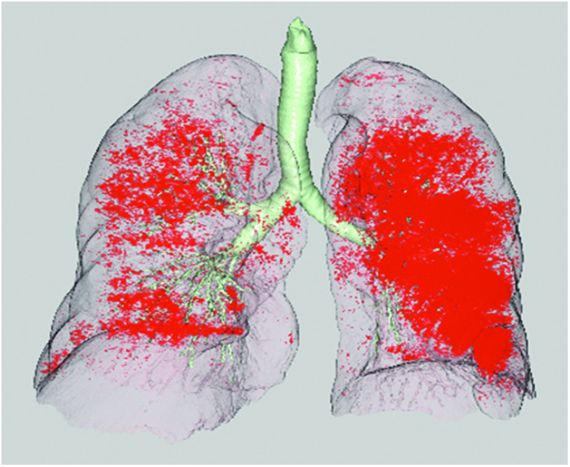 Prediction of Postoperative Respiratory Complications after Lobectomy in Lung Cancer Patients with COPD by Quantitative Image Analysis: A Historical Cohort Study.