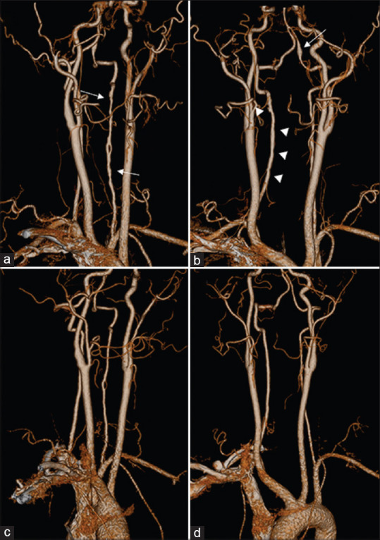 Extracranial reversible cerebral vasoconstriction syndrome associated with vertebral artery dissection: A case report.