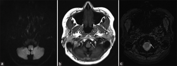 Extracranial reversible cerebral vasoconstriction syndrome associated with vertebral artery dissection: A case report.