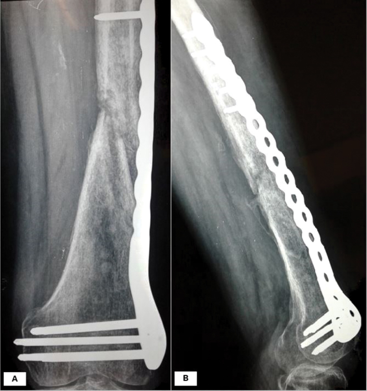 Femur Osteomyelitis and Associated Fracture as an Initial Presentation of Aortoenteric Fistula.