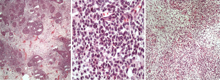 A rare case of primary ovarian mesenchymal chondrosarcoma in pregnancy.