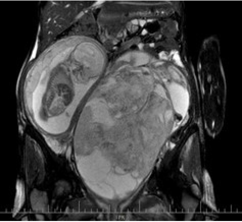 A rare case of primary ovarian mesenchymal chondrosarcoma in pregnancy.