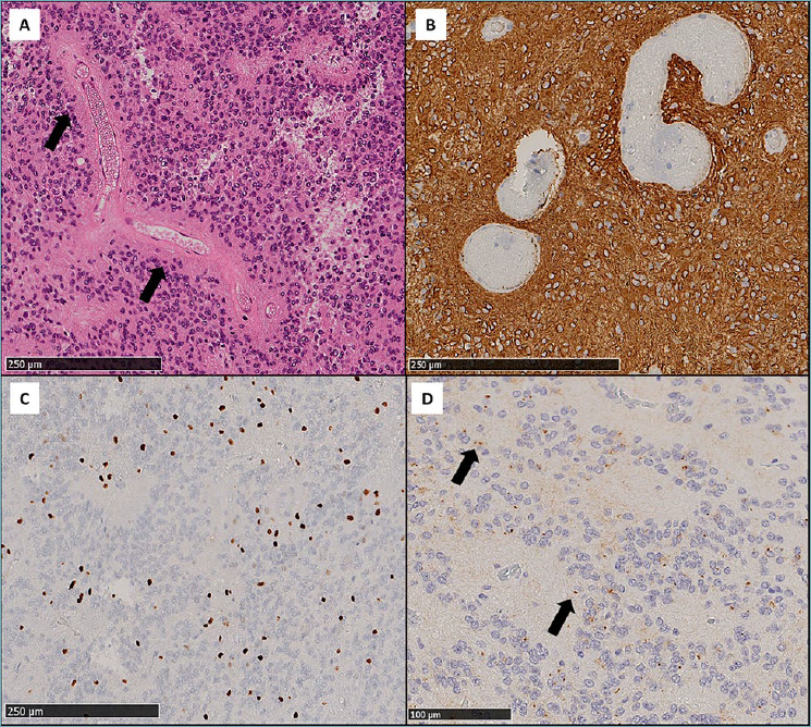 Ependymomas.