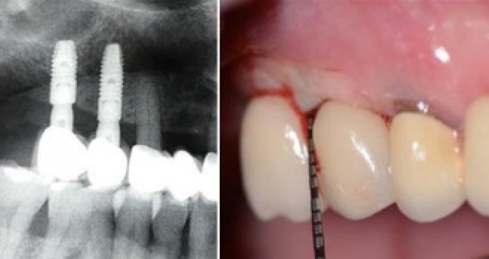 Porphyromonas Gingivalis in Different Peri-Implant Conditions: a Pilot Cross - Sectional Study.