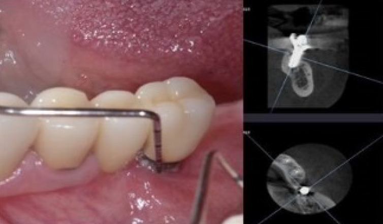 Porphyromonas Gingivalis in Different Peri-Implant Conditions: a Pilot Cross - Sectional Study.