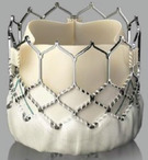 Transcatheter pulmonary valve replacement in congenital heart diseases.