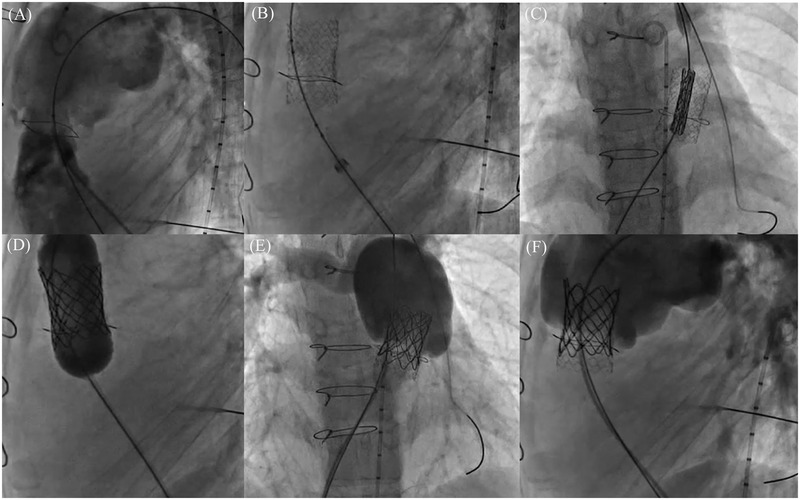 Transcatheter pulmonary valve replacement in congenital heart diseases.