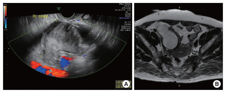 Appendiceal mucocele masquerading as an epithelial borderline ovarian tumor: a case report and literature review.