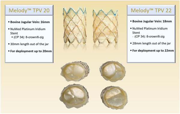 Transcatheter pulmonary valve replacement in congenital heart diseases.