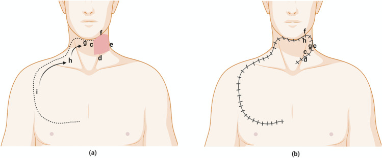 The contralateral based Cervico-pectoral rotation flap for large neck defects.