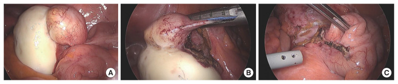 Appendiceal mucocele masquerading as an epithelial borderline ovarian tumor: a case report and literature review.