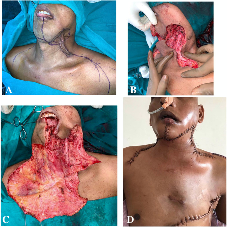 The contralateral based Cervico-pectoral rotation flap for large neck defects.