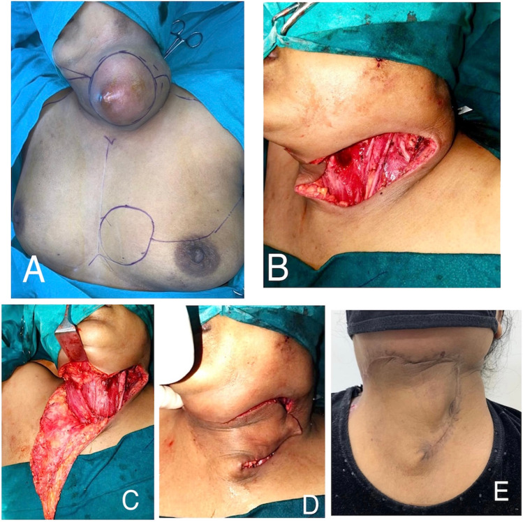 The contralateral based Cervico-pectoral rotation flap for large neck defects.