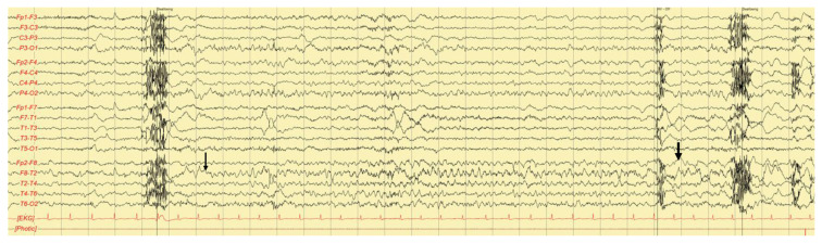 Cerebral Salt Wasting Syndrome Associated with Status Epilepticus.