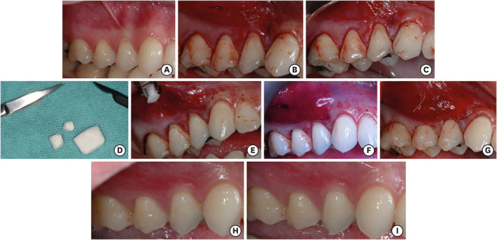 Clinical and patient-reported outcomes after recession coverage using modified vestibular incision subperiosteal tunnel access with a volume-stable collagen matrix as compared to a coronally advanced flap with a subepithelial connective tissue graft.