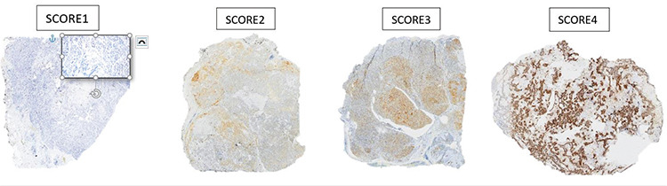 The Importance of Prostate-Specific Membrane Antigen Expression in Salivary Gland Tumors.