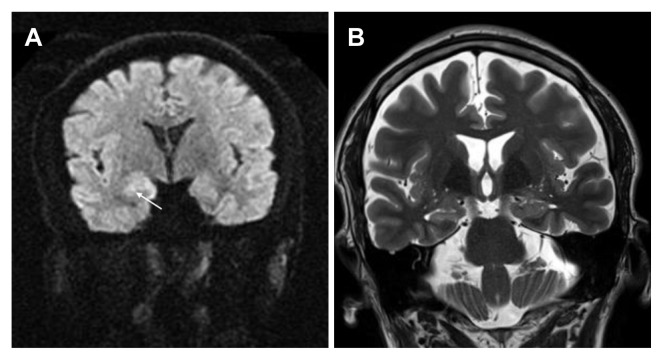 Cerebral Salt Wasting Syndrome Associated with Status Epilepticus.