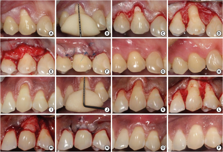 Clinical and patient-reported outcomes after recession coverage using modified vestibular incision subperiosteal tunnel access with a volume-stable collagen matrix as compared to a coronally advanced flap with a subepithelial connective tissue graft.