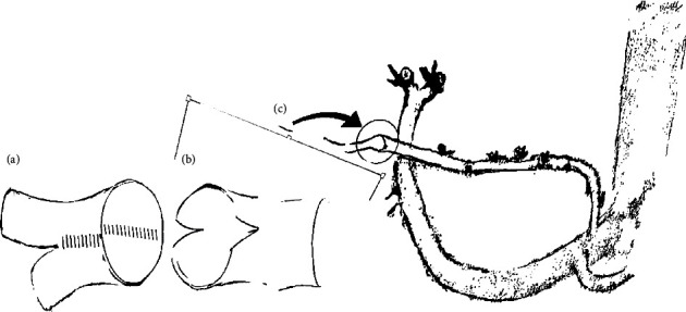 Long-Term Suitability of Left Gastric Artery Inflow for Arterial Perfusion of Living Donor Right Lobe Grafts.