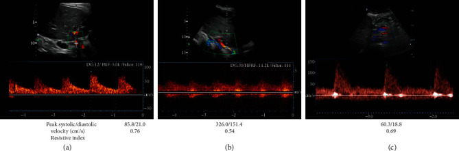 Long-Term Suitability of Left Gastric Artery Inflow for Arterial Perfusion of Living Donor Right Lobe Grafts.