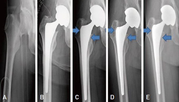 Results of Hip Arthroplasty Using a COREN Stem at a Minimum of Ten Years.