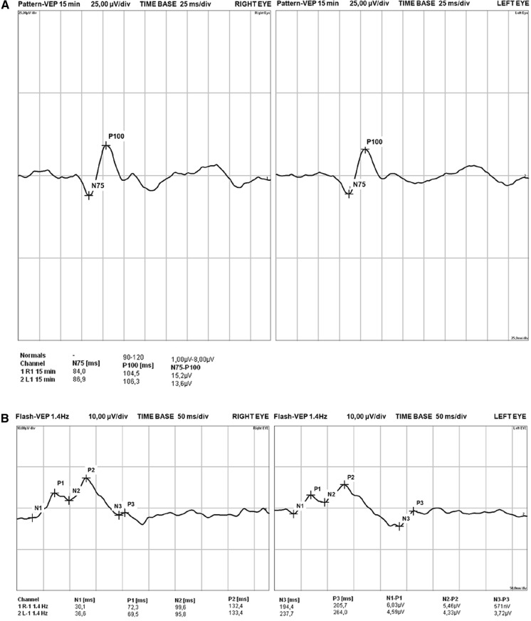 Visual evoked potentials as a method for the prospective assessment of tacrolimus neurotoxicity in patients after kidney transplantation.