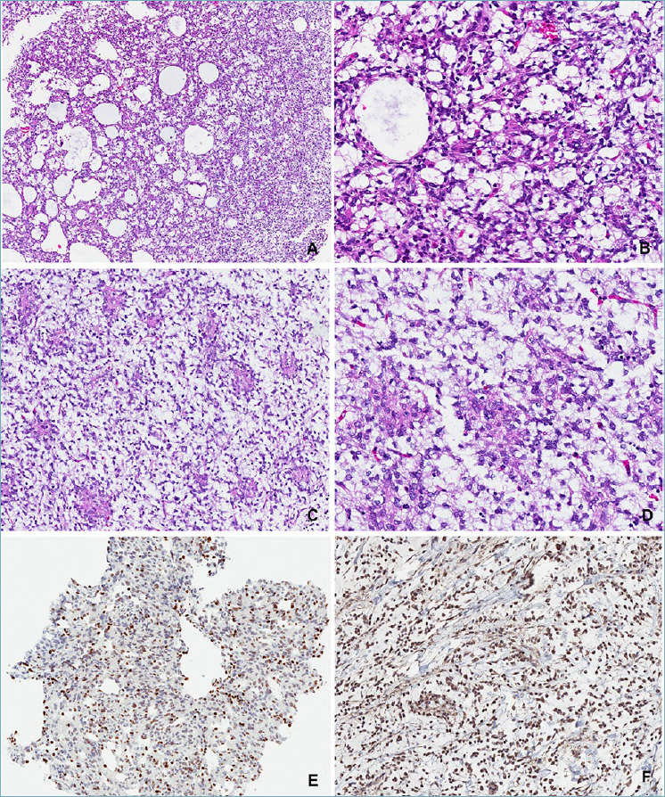 Expanding the spectrum of "mesenchymal" tumors of the central nervous system.