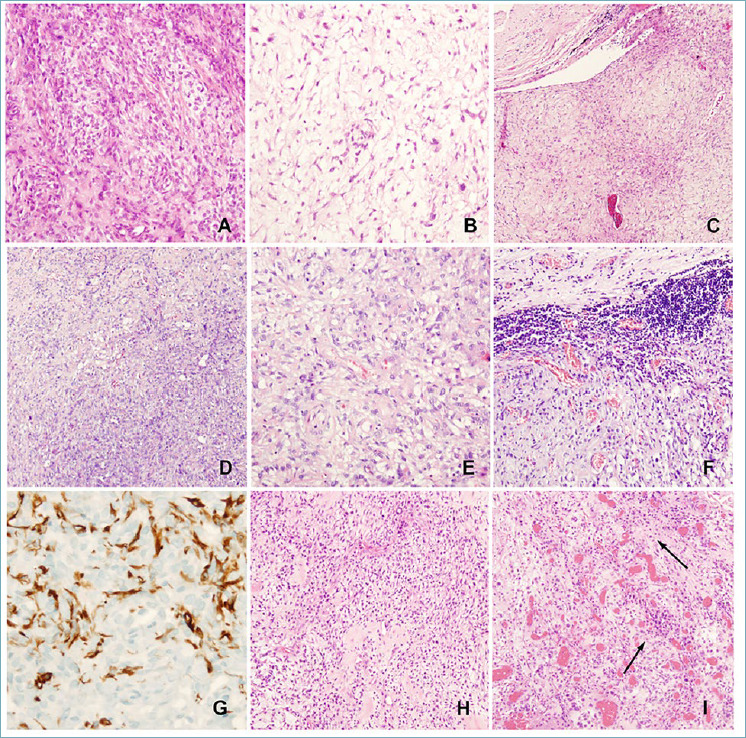 Expanding the spectrum of "mesenchymal" tumors of the central nervous system.