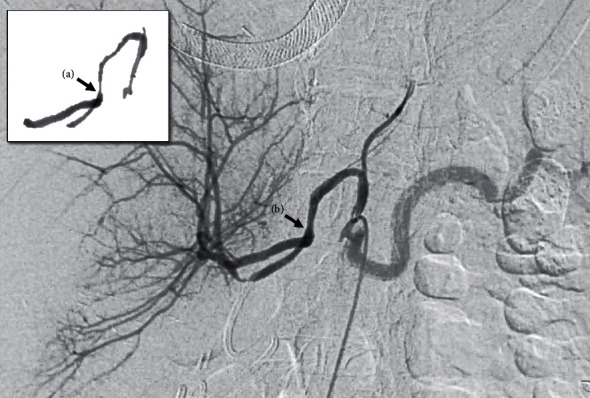 Long-Term Suitability of Left Gastric Artery Inflow for Arterial Perfusion of Living Donor Right Lobe Grafts.